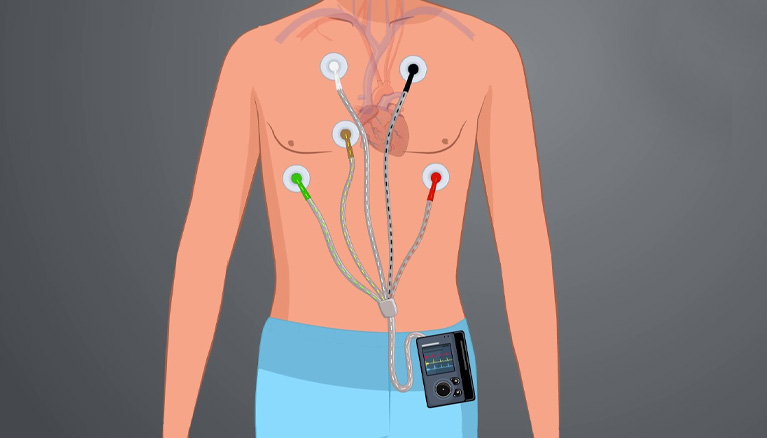 Holter Monitoring
